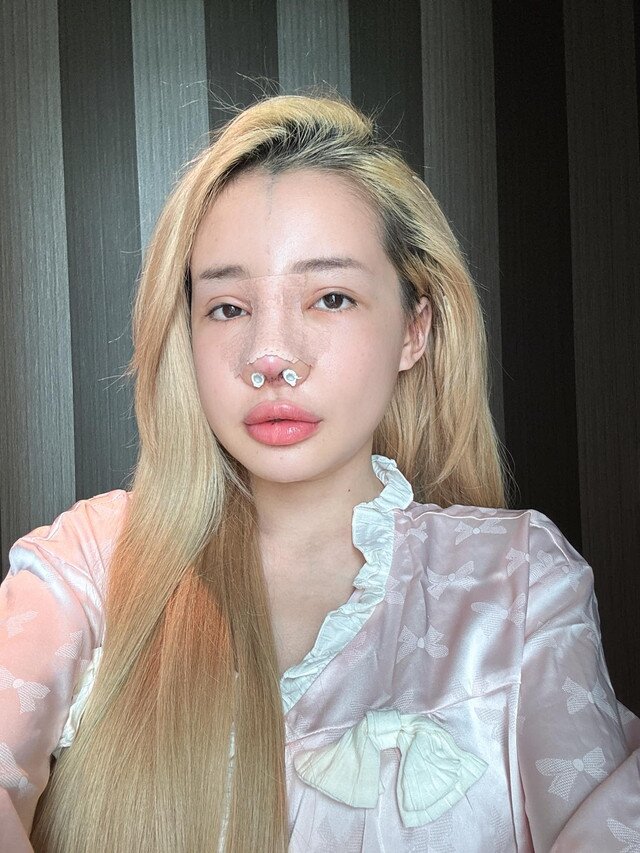 Sau 12 lần phẫu thuật thẩm mỹ rồi bị co rút mũi, Ngân 98 lại tiếp tục &#34;gặp biến&#34; khiến dân tình tá hoả - 5